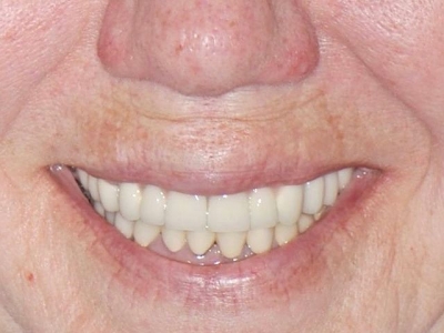 После восстановления зубов