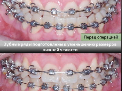 До и после лечения брекет-системой.