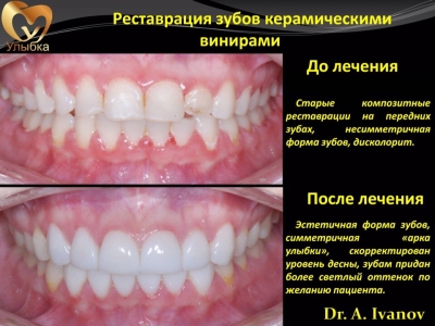 Реставрация зубов керамическими винирами.