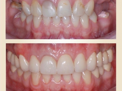 Восстановление зубного ряда с помощью имплантации