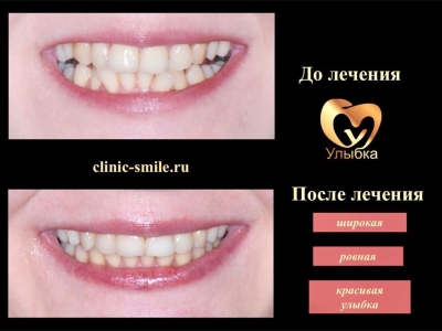 До и после лечения брекет-системой.