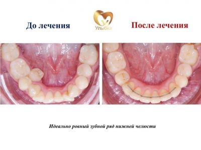 До и после лечения брекет-системой.