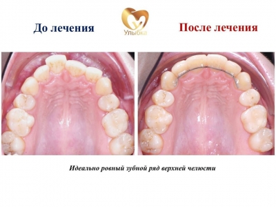 До и после лечения брекет-системой.