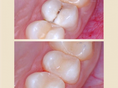 Лечение корневых каналов зуба.