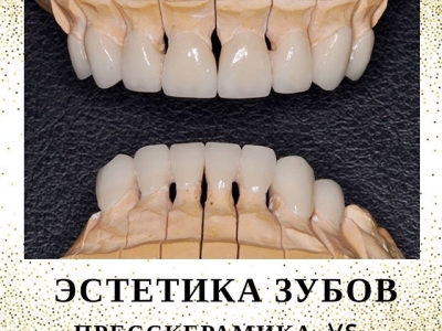 Эстетика зубов при помощи коронок.