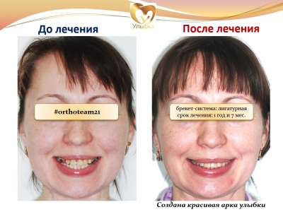 До и после лечения брекет-системой._1