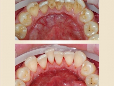 До и после профессиональной гигиены полости рта._2