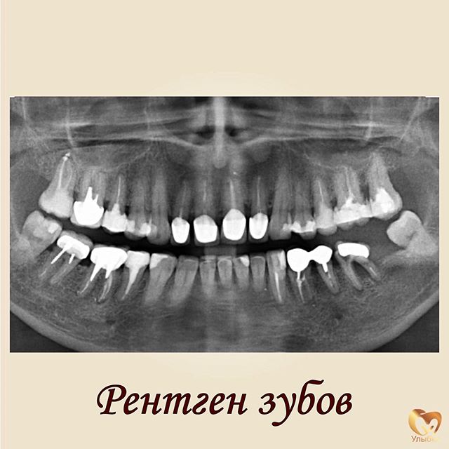 Рентгеновский снимок зуба